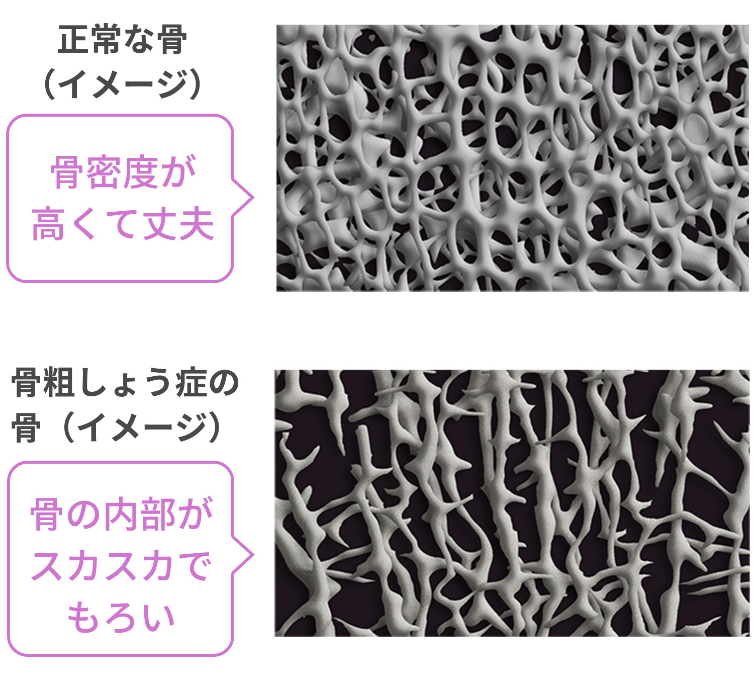 正常な骨（イメージ）骨密度が高くて丈夫 骨粗しょう症の骨（イメージ）骨の内部がスカスカでもろい