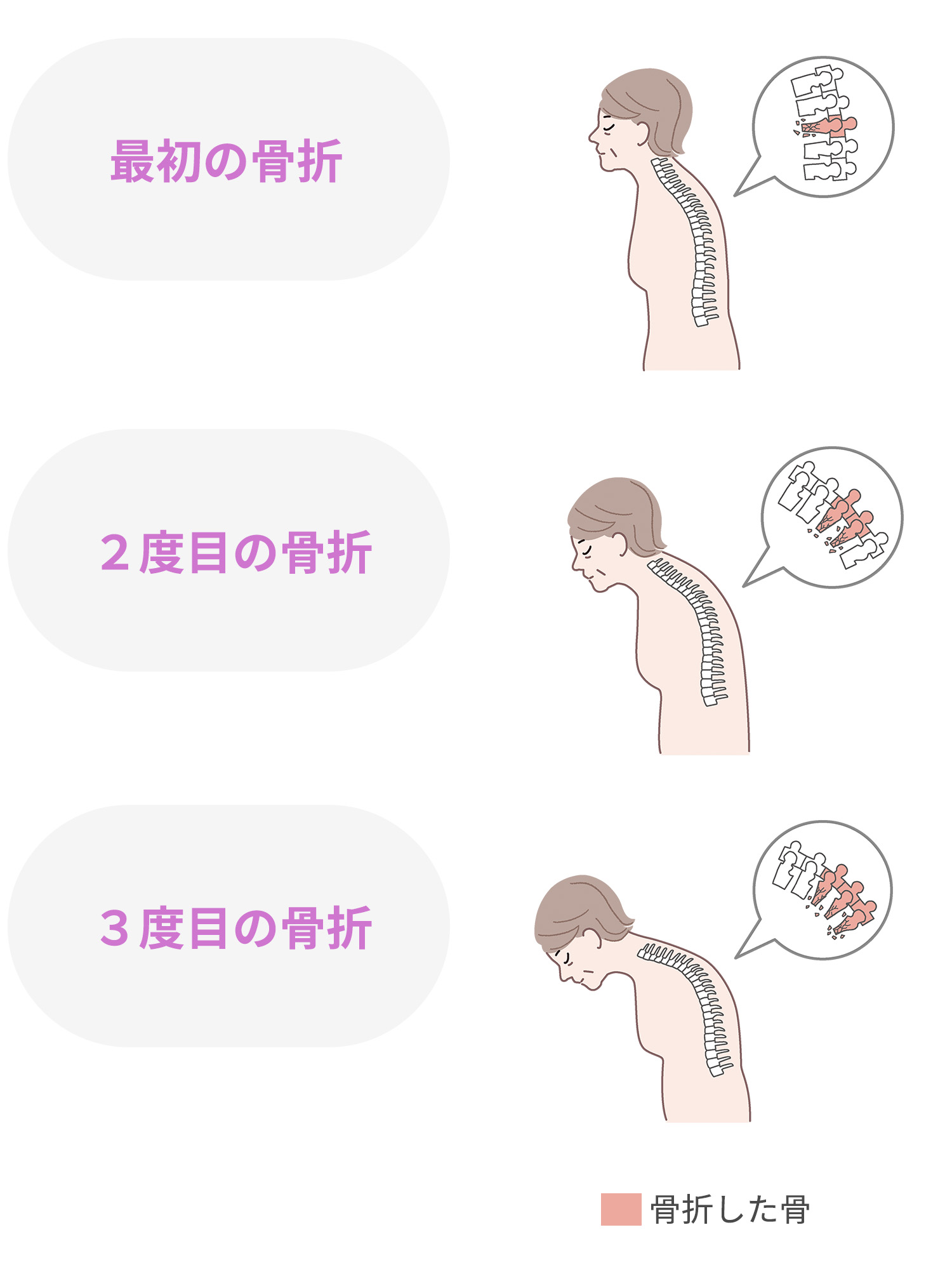 最初の骨折 ２度目の骨折 ３度目の骨折