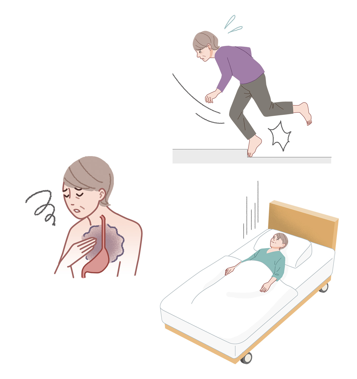 ドミノ骨折の症状のイラスト